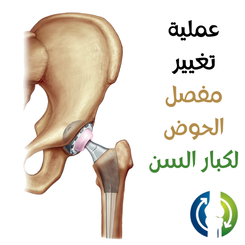 عملية تغيير مفصل الحوض لكبار السن